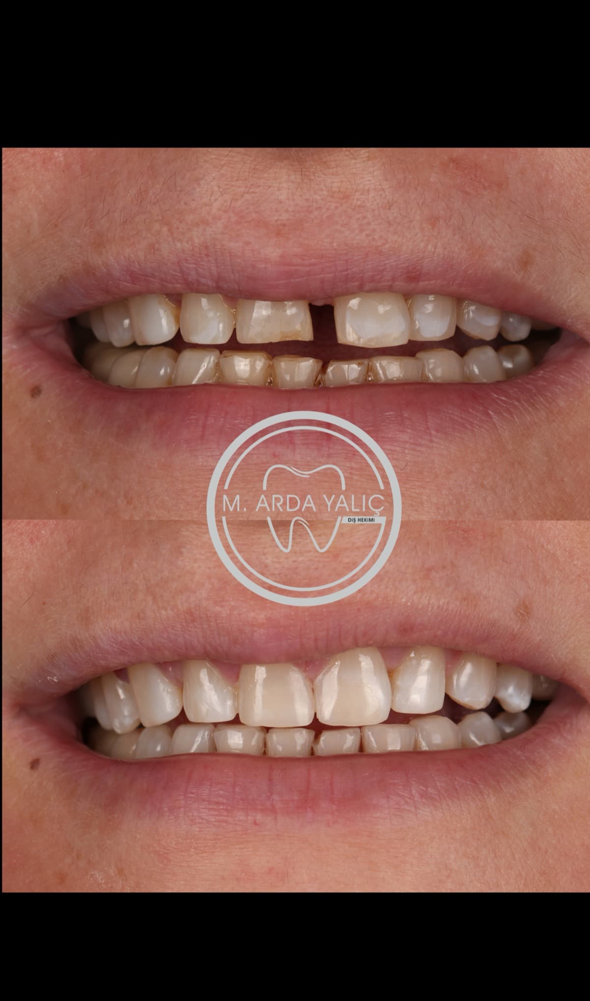 Dental treatment before and after result 17