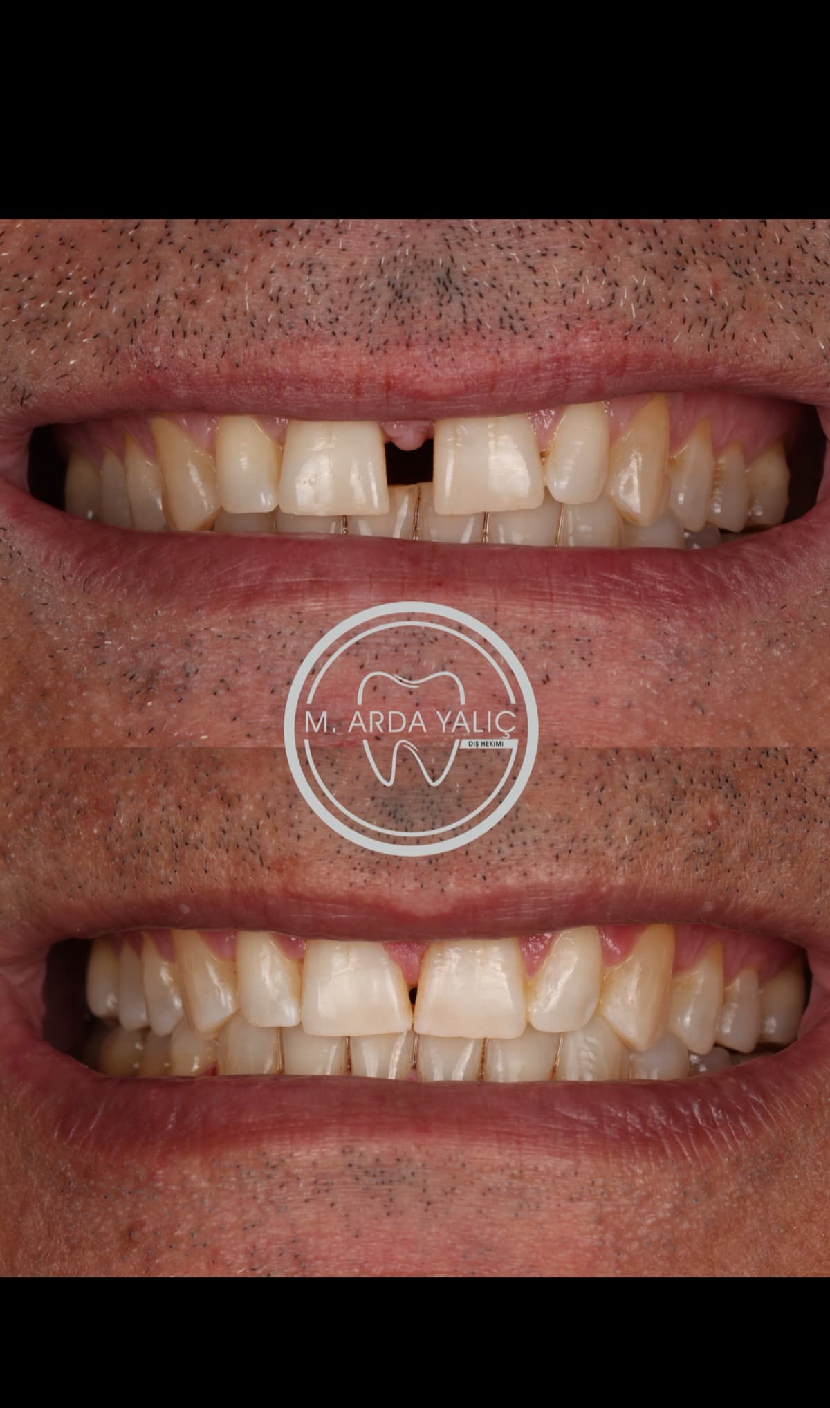 Dental treatment before and after result 20