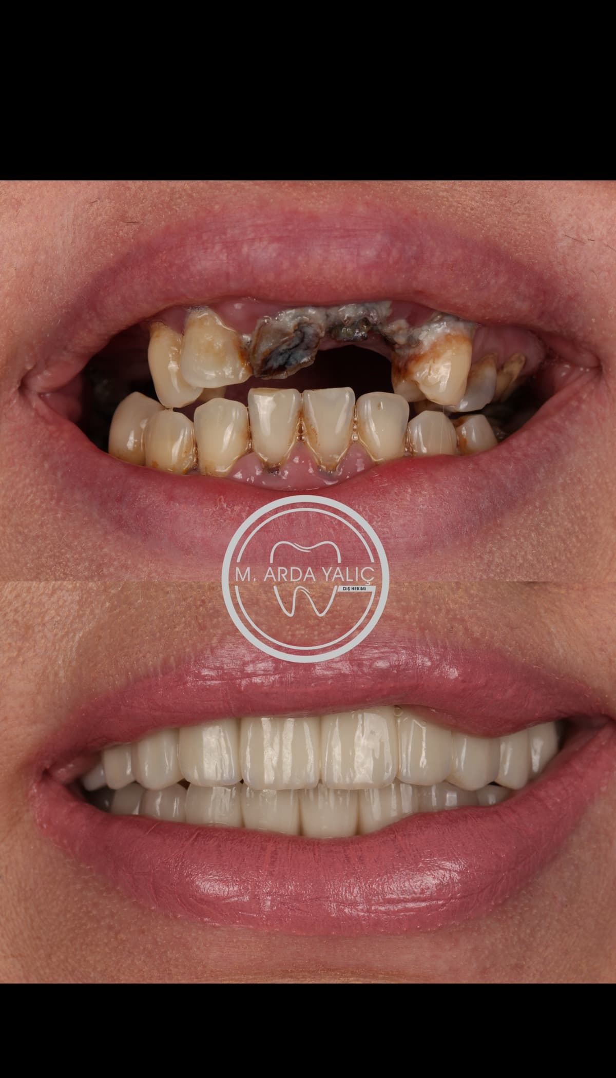 Dental treatment before and after result 30