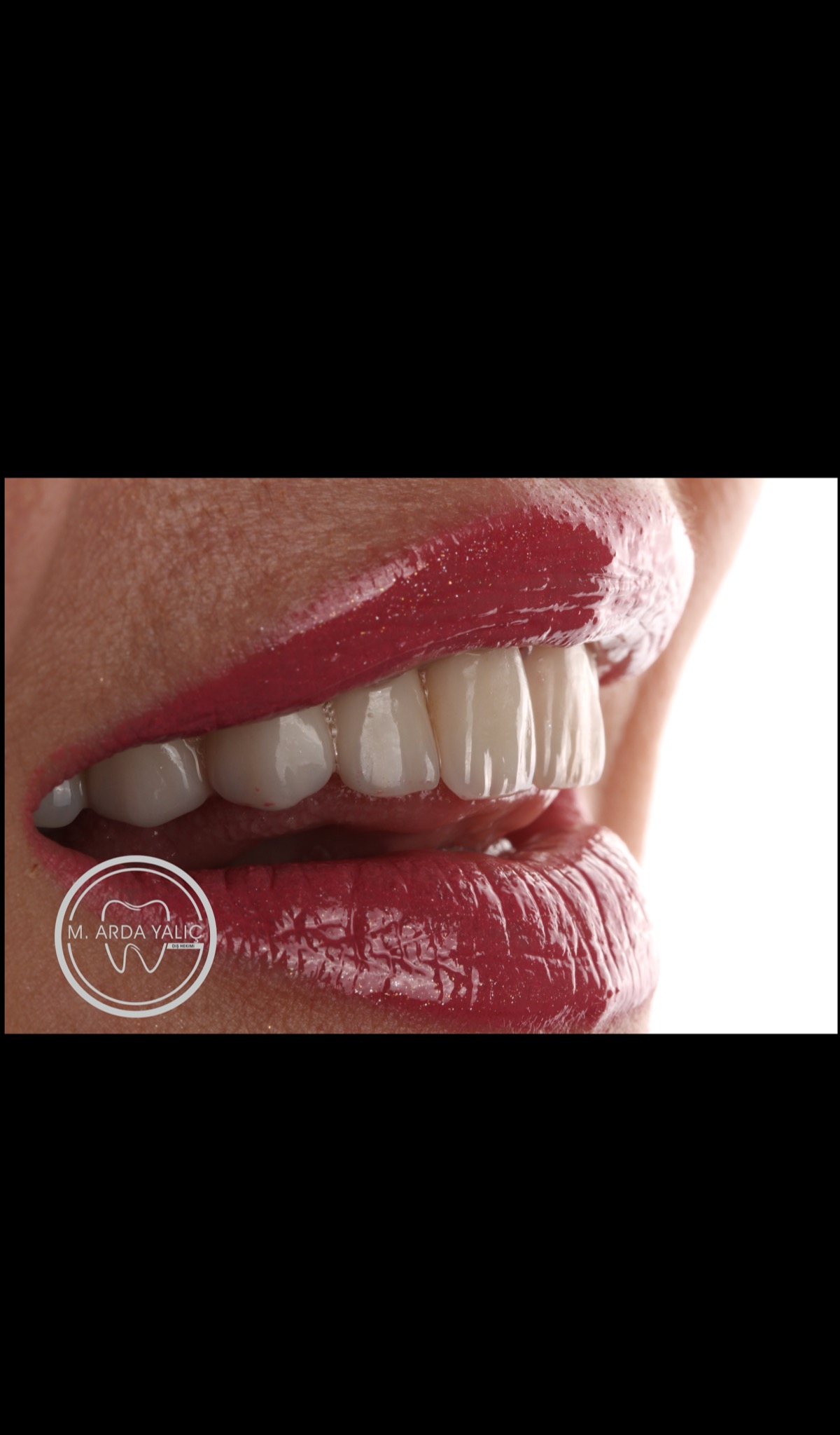 Dental treatment before and after result 13