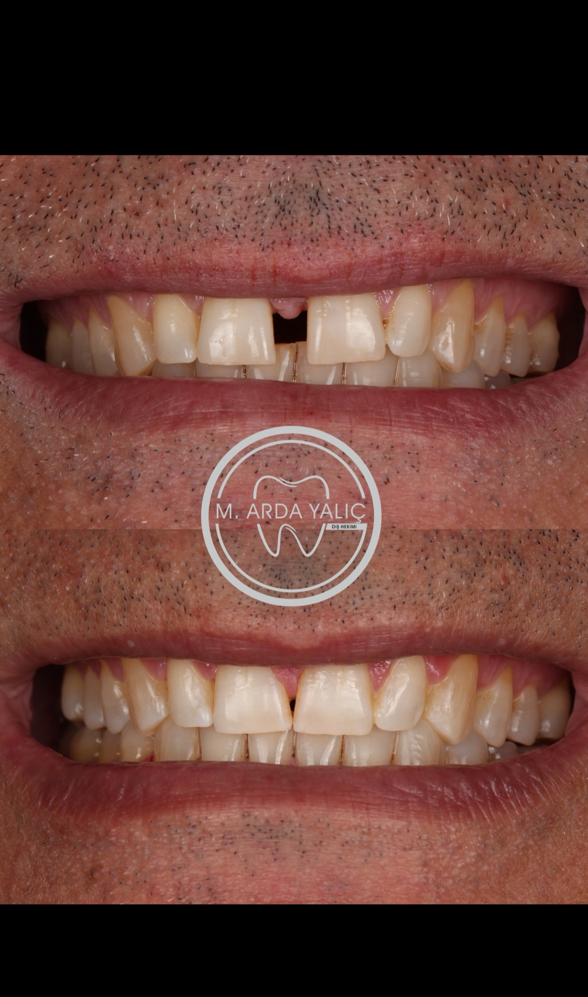 Dental treatment before and after result 20