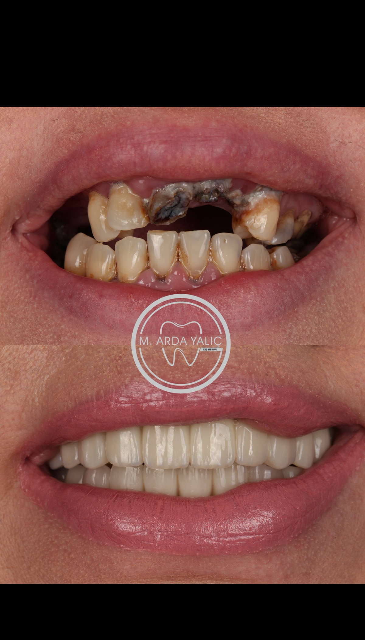 Dental treatment before and after result 30