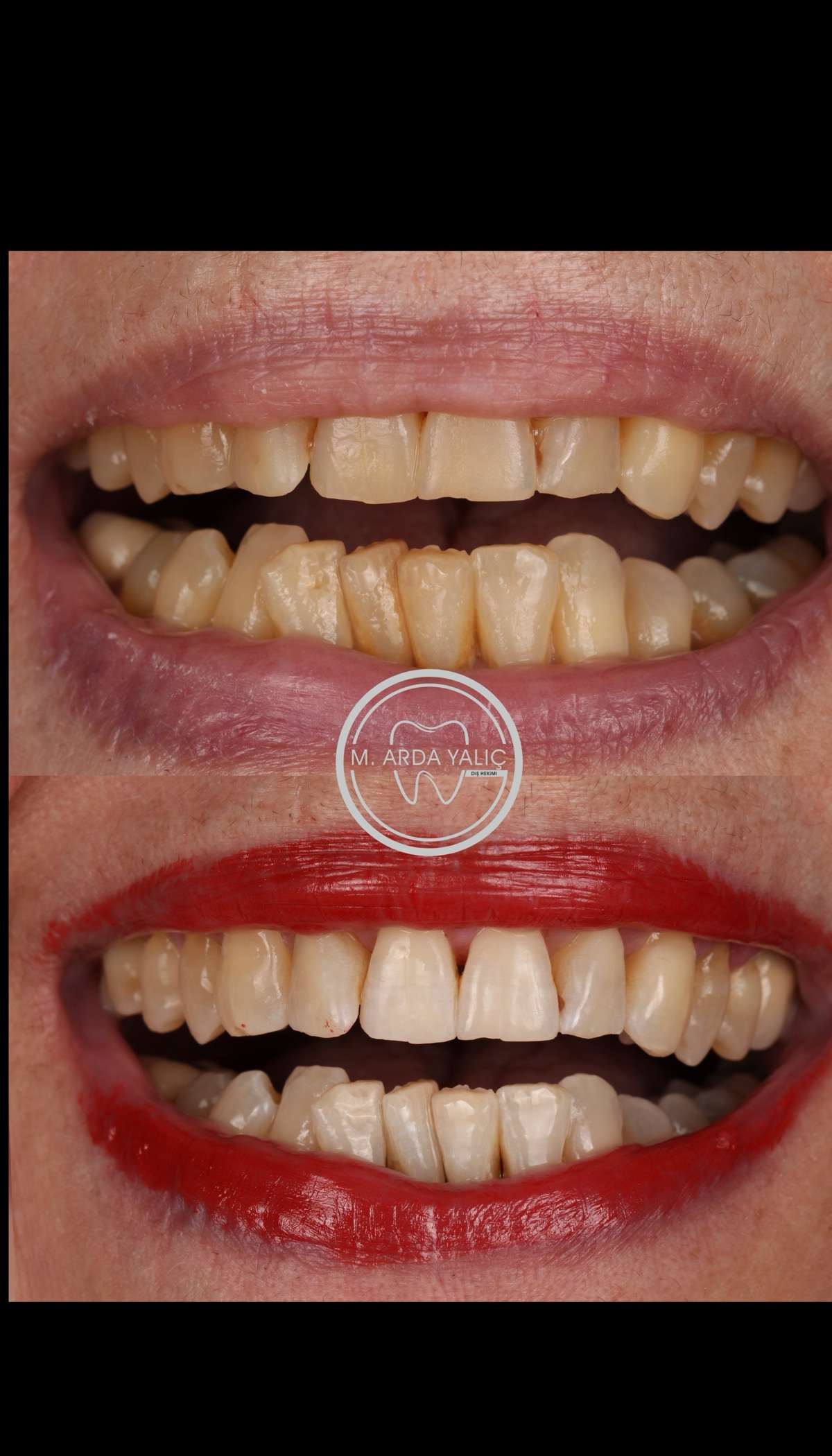 Dental treatment before and after result 32
