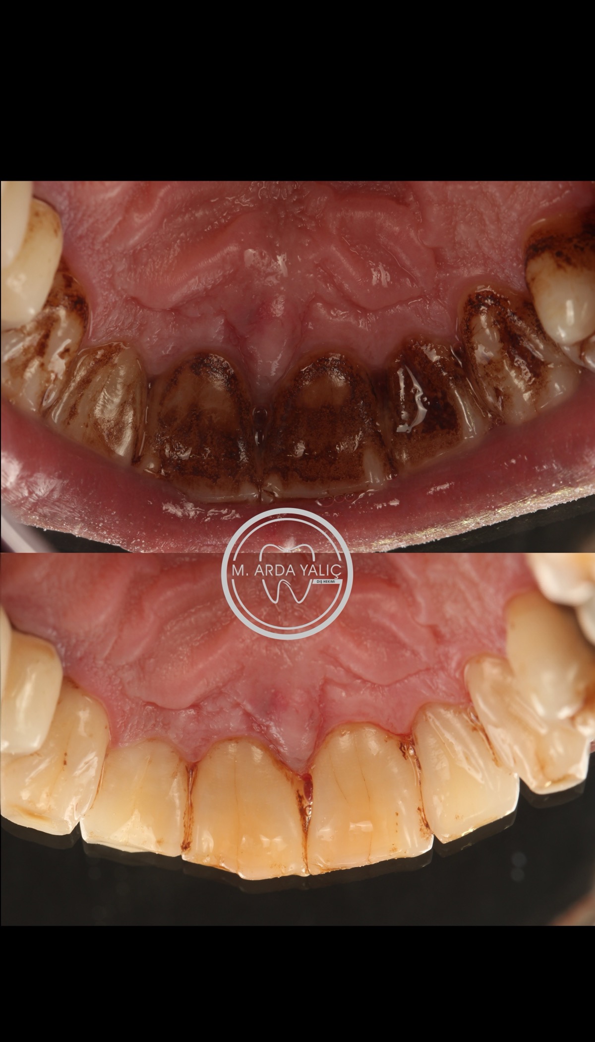 Dental treatment before and after result 36